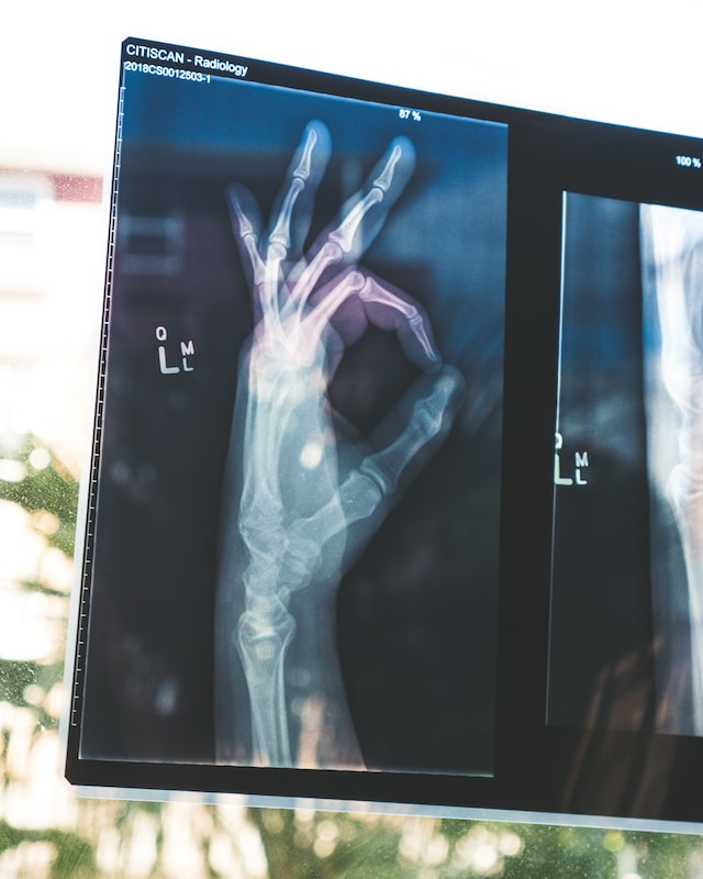 Common Causes of Arm Fractures and How to Stay Safe