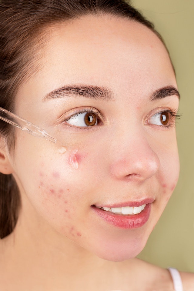 Say Goodbye to Acne on a Budget: 15 Easy and Affordable Solutions