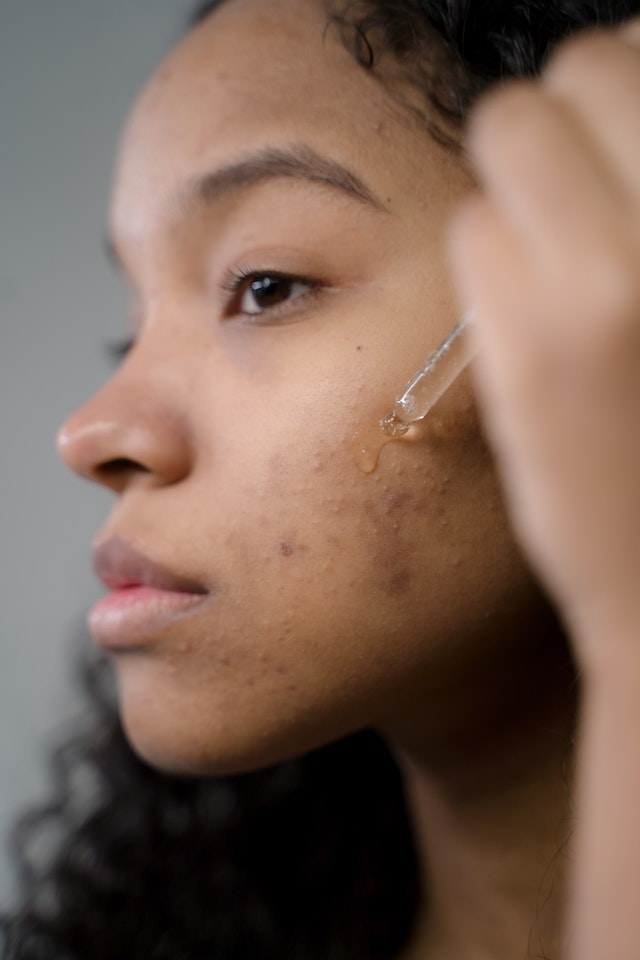 Bidding Acne Farewell How Serums Transform Your Complexion