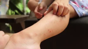 Mosquito Bites 