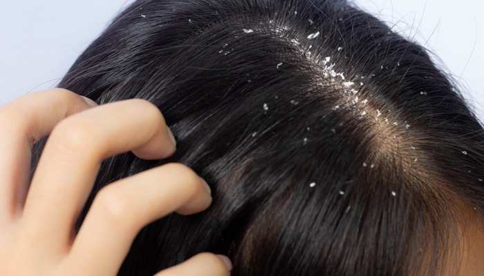 Jen Atkin’s Scalp SOS: Unraveling the Mysteries of Dryness and Dandruff Causes