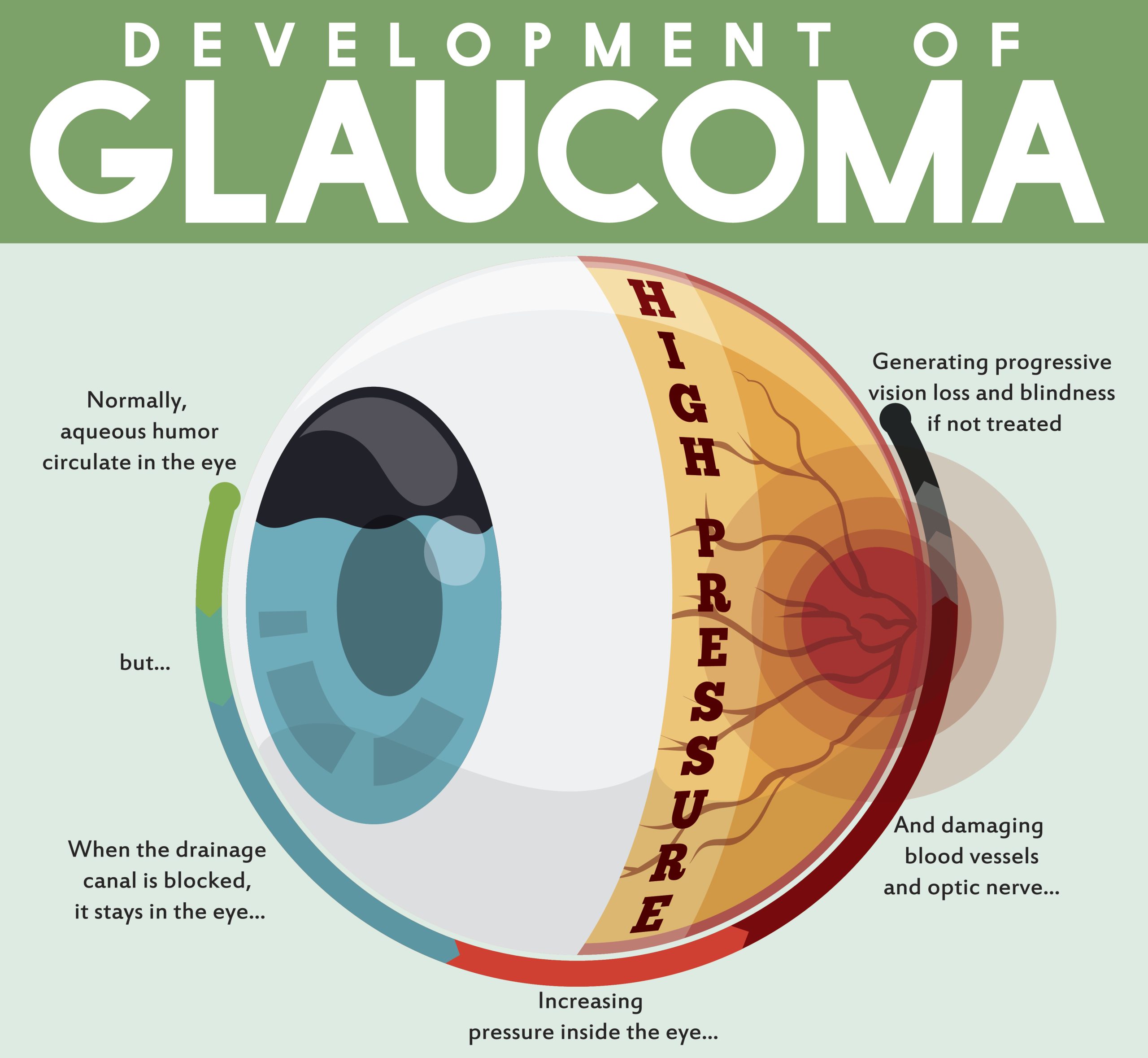 Targeted Treatment: Precision Gene Therapy for Glaucoma