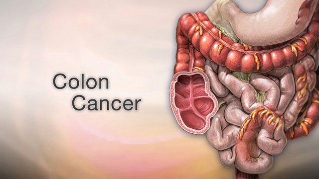 Colon Cancer and Prevention