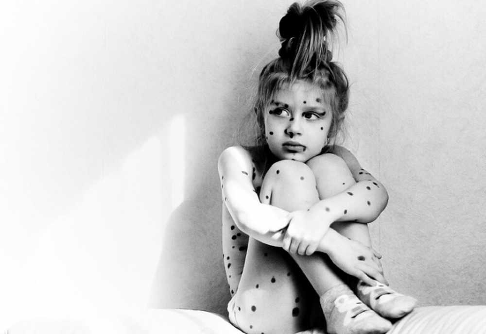 The Story of Chickenpox: What You Need to Know