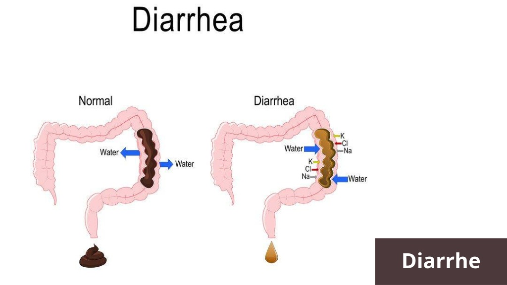 Understanding Diarrhea: Causes, Symptoms, and Treatment Options