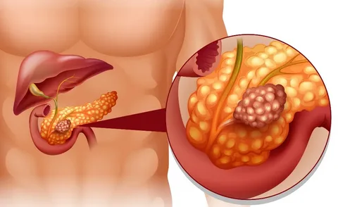 Talking about Tumors: How Insulinoma Affects Blood Sugar