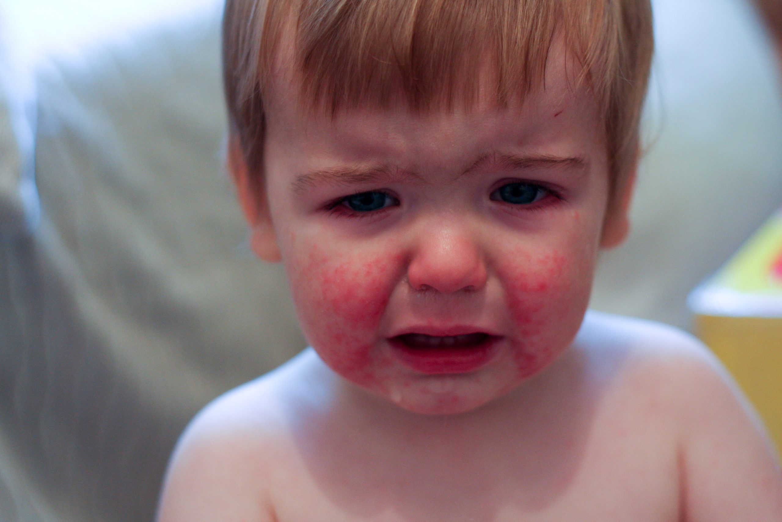 Beyond the Fever: Learning about Signs and Treatments for Kawasaki Disease