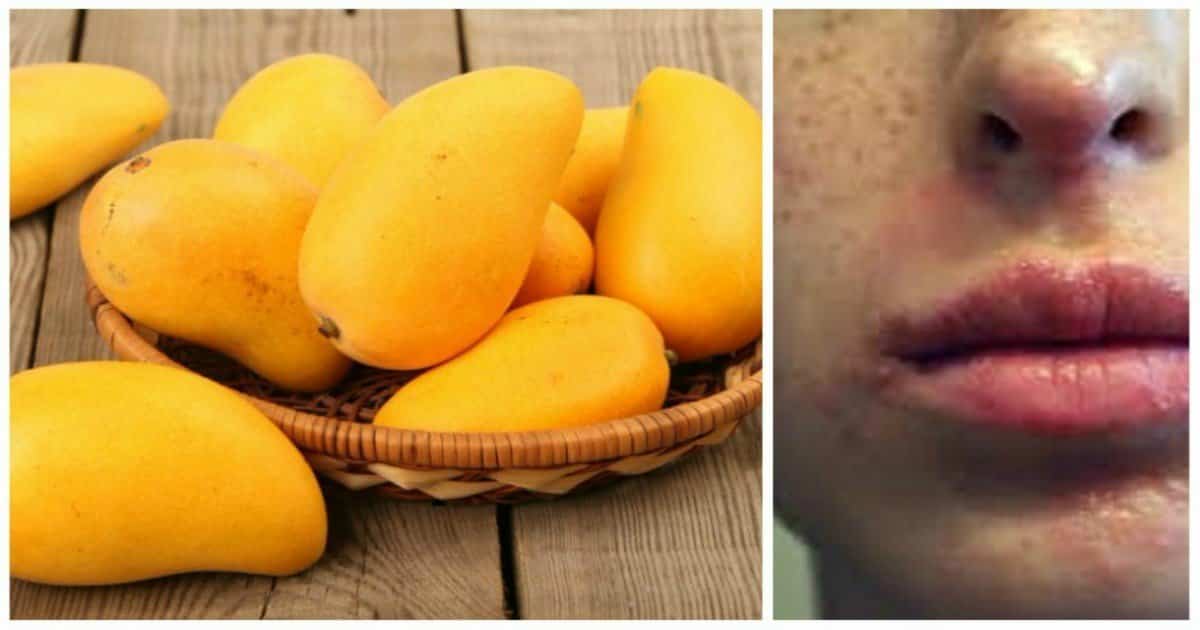 Mysteries of Mango Allergy: Causes, Symptoms, and Treatment