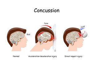 recognizing concussion signs