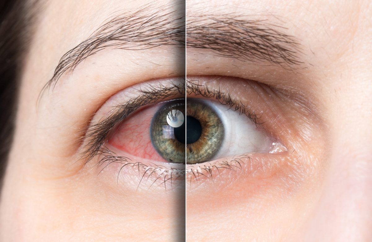 Dry Eye Therapies