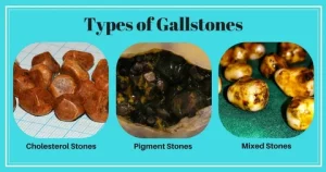 Gallbladder Health