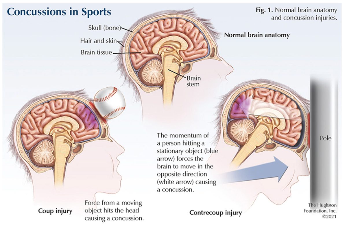 Link Between Concussions in Sports and Alzheimer's Risk