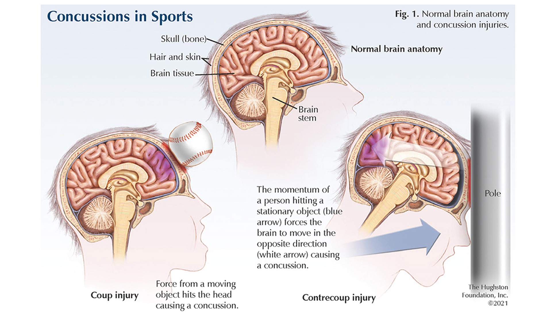 Link Between Concussions in Sports and Alzheimer’s Risk